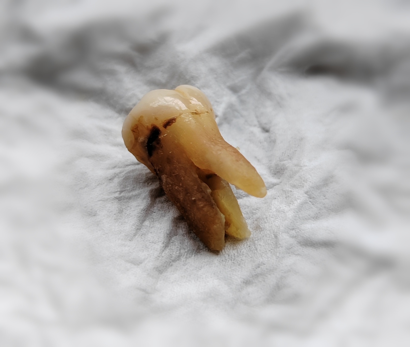 这是左上边第二颗(从里往外)大牙,之前第一颗大牙是去医院拔的,没多久