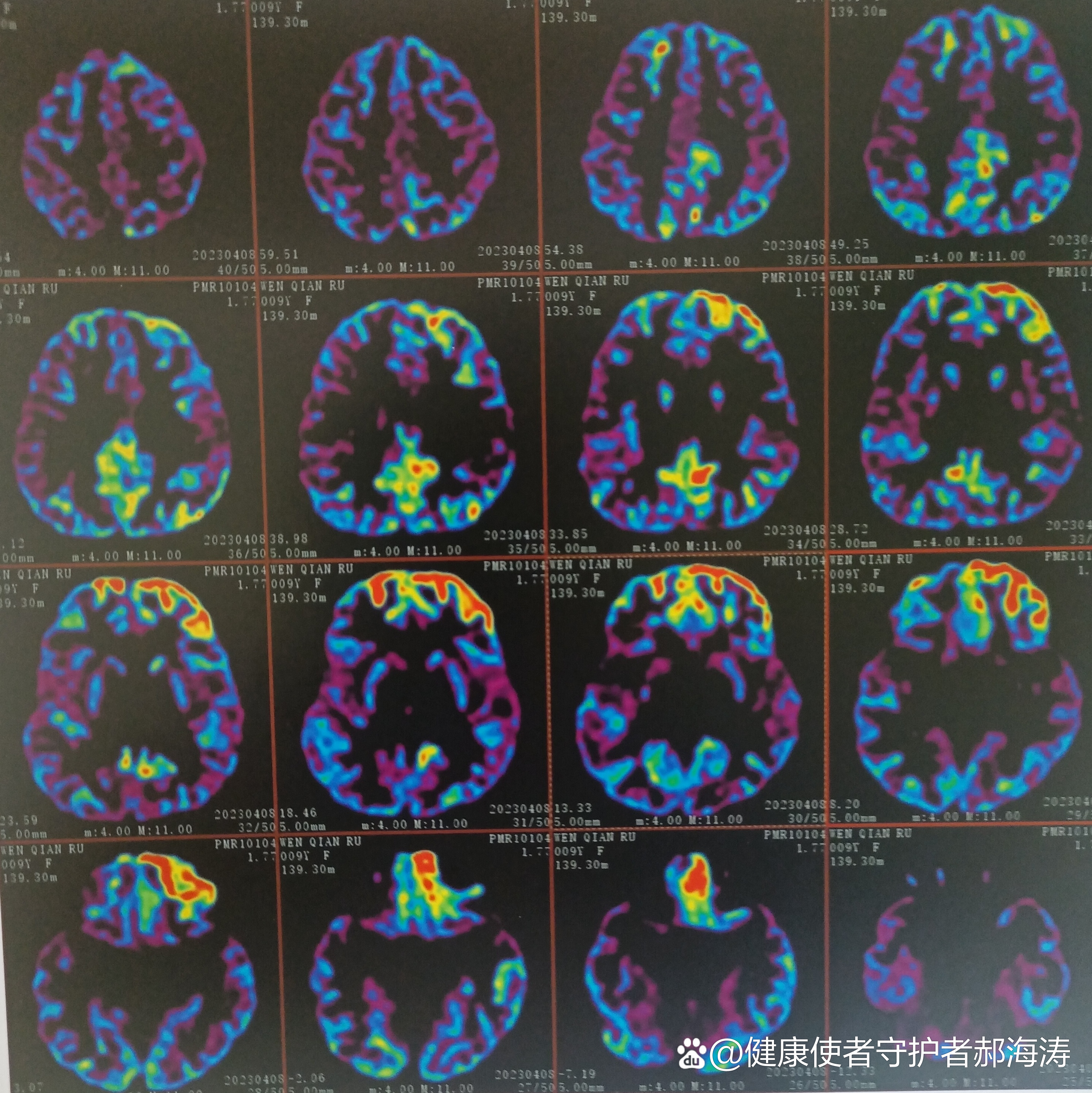 儿童脑电图全脑放电图片