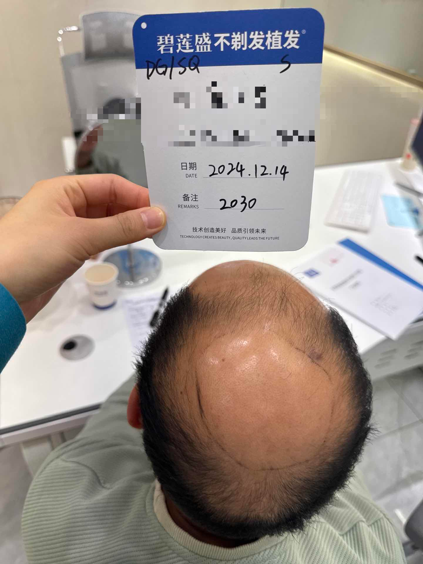 我头顶大面积脱发,超级明显,然后我刷到碧莲盛后,就抽空去面诊了
