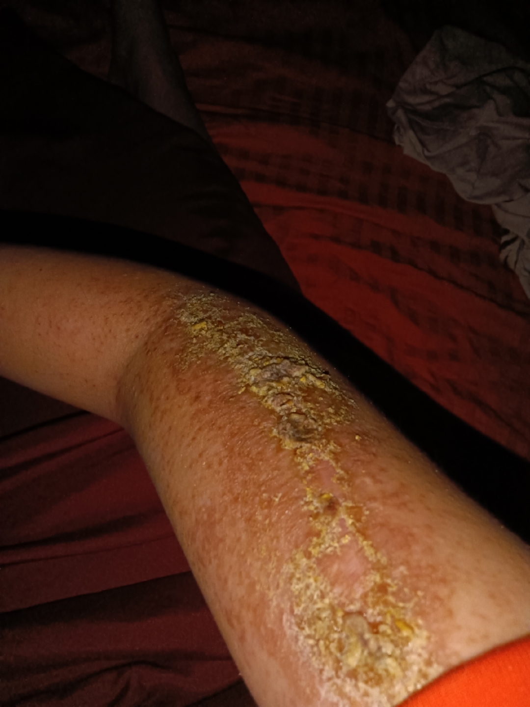 拆钢板两个月了 做的免拆线 可是现在成这样了,而且还好痒  去过医院