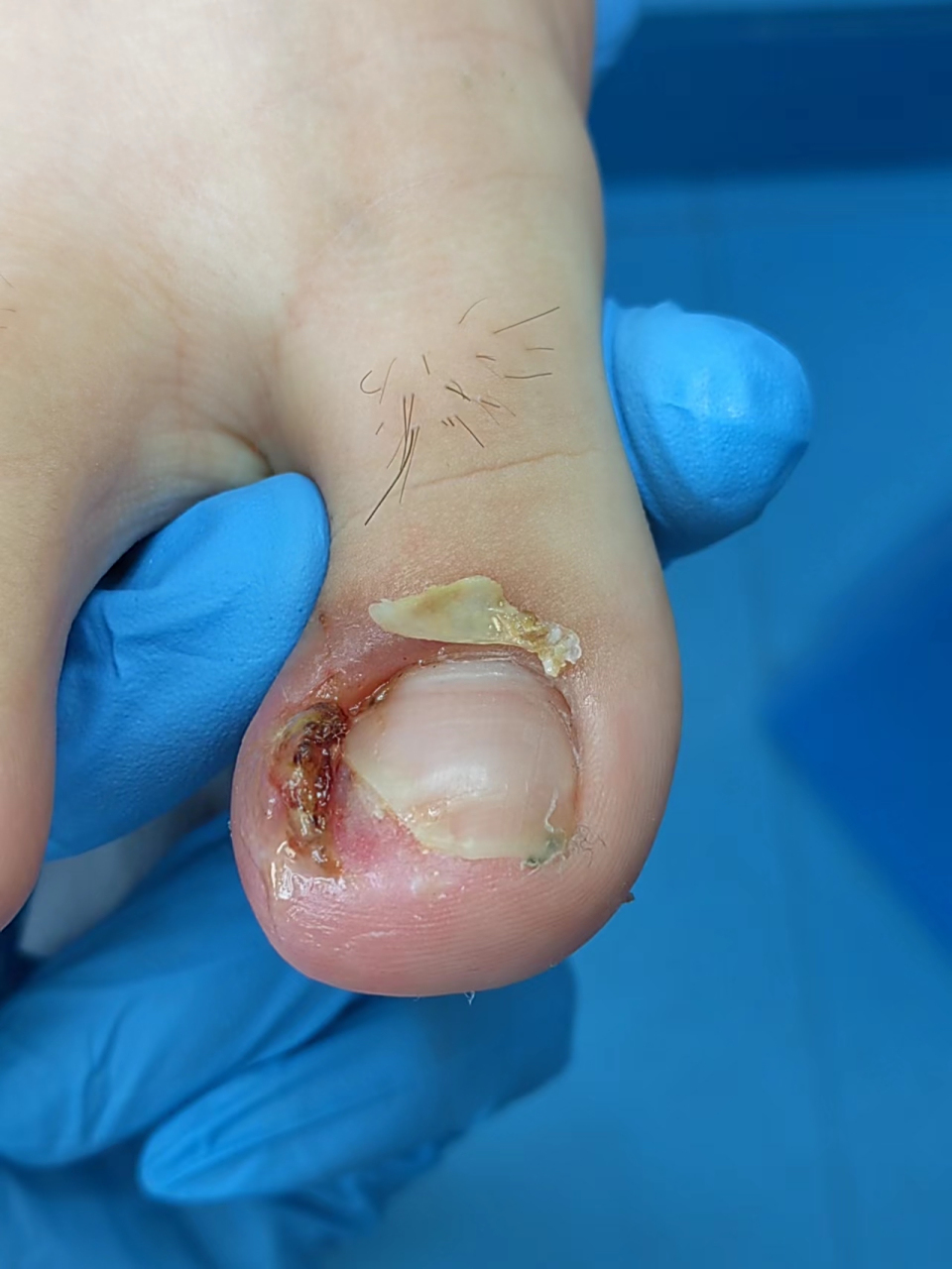 真是东莞甲沟炎患者的福地呀!