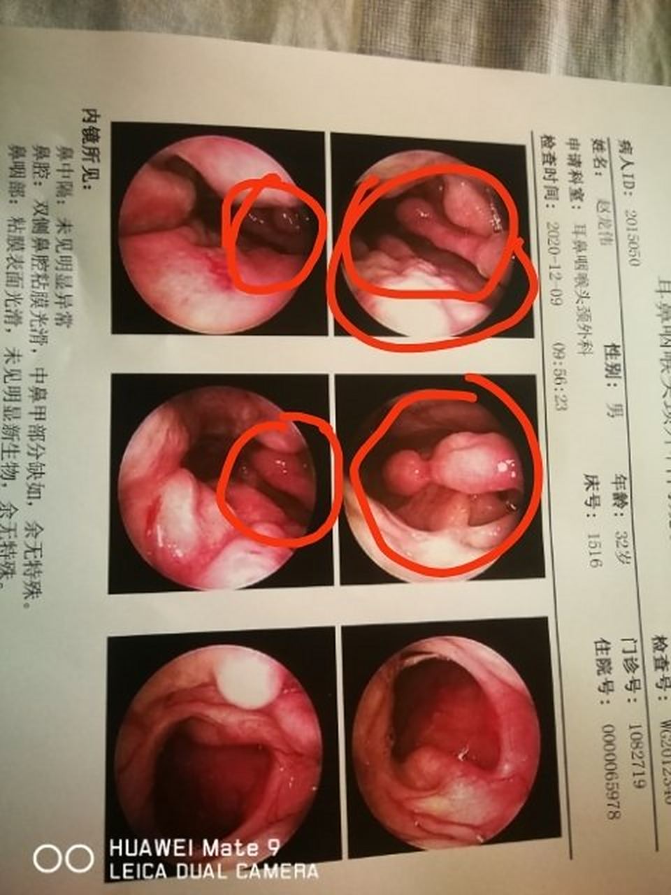 现在更加空了呼吸感觉不到气流,空鼻症本来下鼻甲就缺失,这次颜永毅又