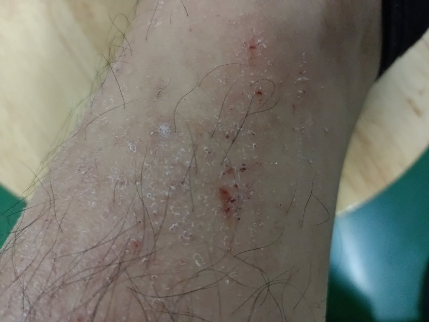 这脚上为什么会变成这样,好痒好难受,都抓坏了,这个是什么病?
