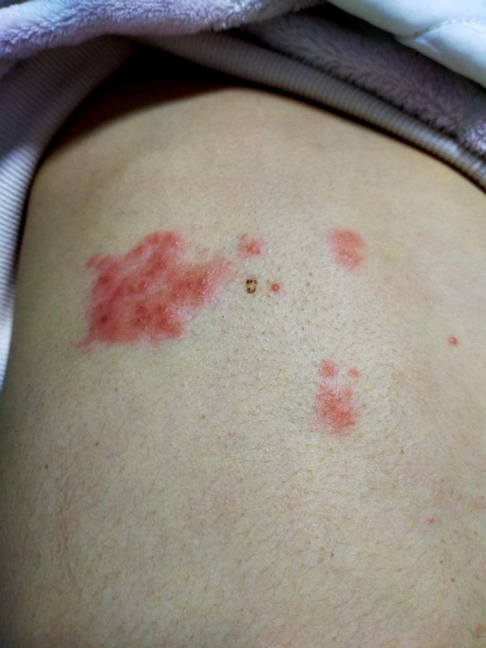 这是什么疮毒,该用什么药物?