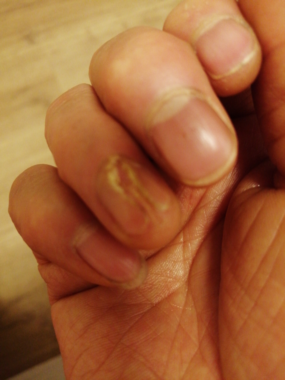 指甲为啥中间裂开?