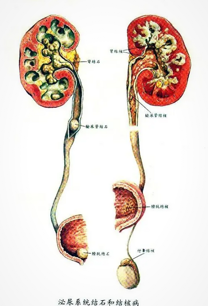 尿结石##尿结石是怎么引起的#尿路结石形成的原因很多,应该是归结起