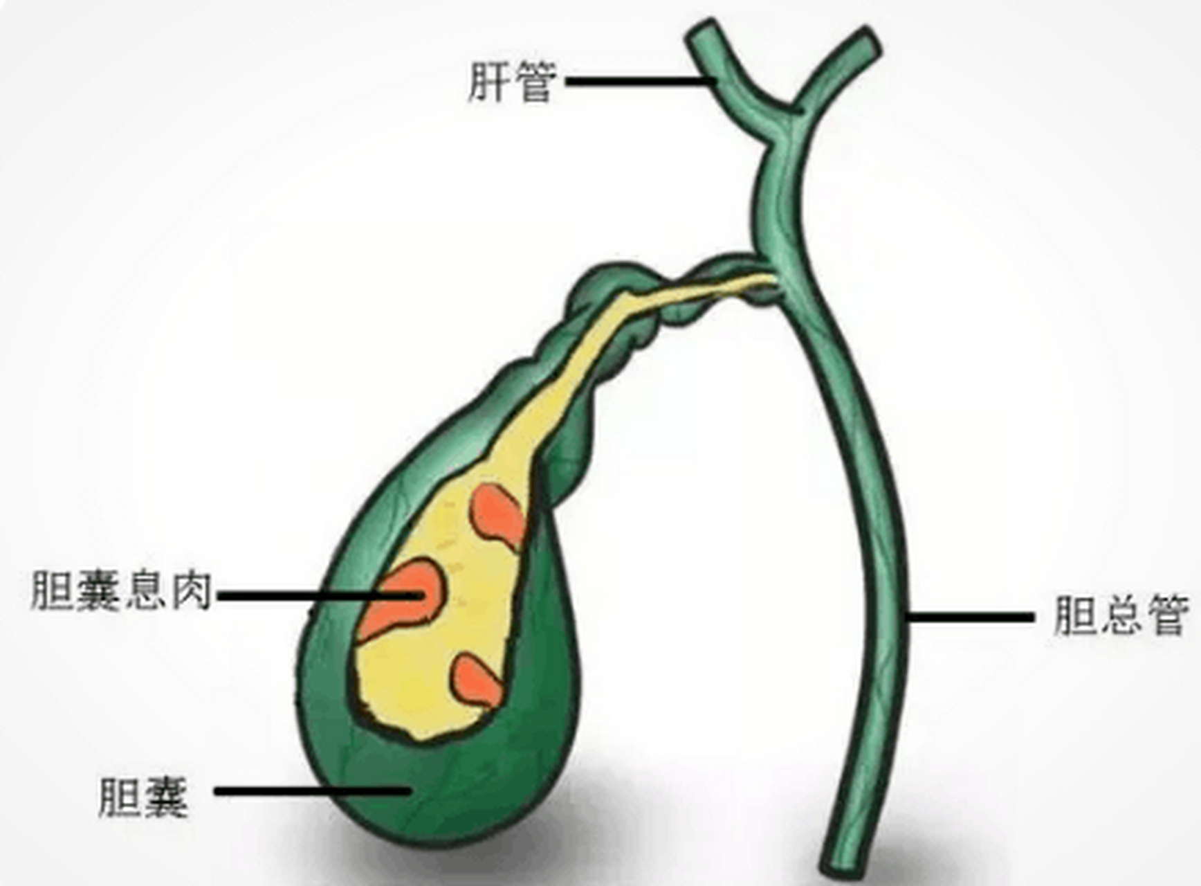 胆囊息肉##胆囊息肉能自愈吗#胆囊息肉是各种胆囊粘膜良性隆起的简称