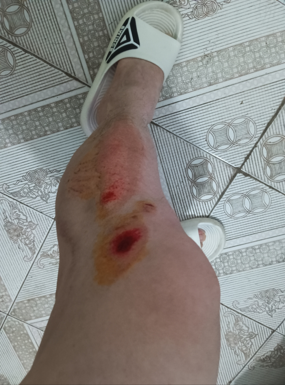 昨晚骑摩托送单路上摔倒了,手脚都划伤了,痛啊!