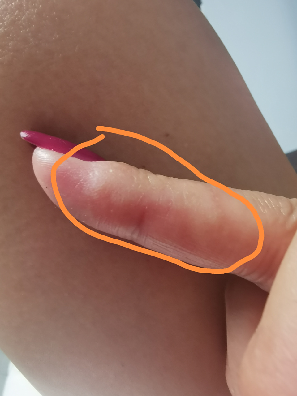 手指一侧有点硬还有点肿,按压会有疼痛感,起什么原因?