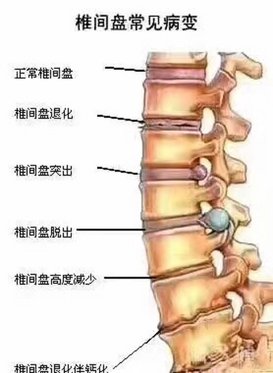 腰肌劳损是在提醒你 你的椎间盘已经开始退化,腰椎也开始钙化,等你