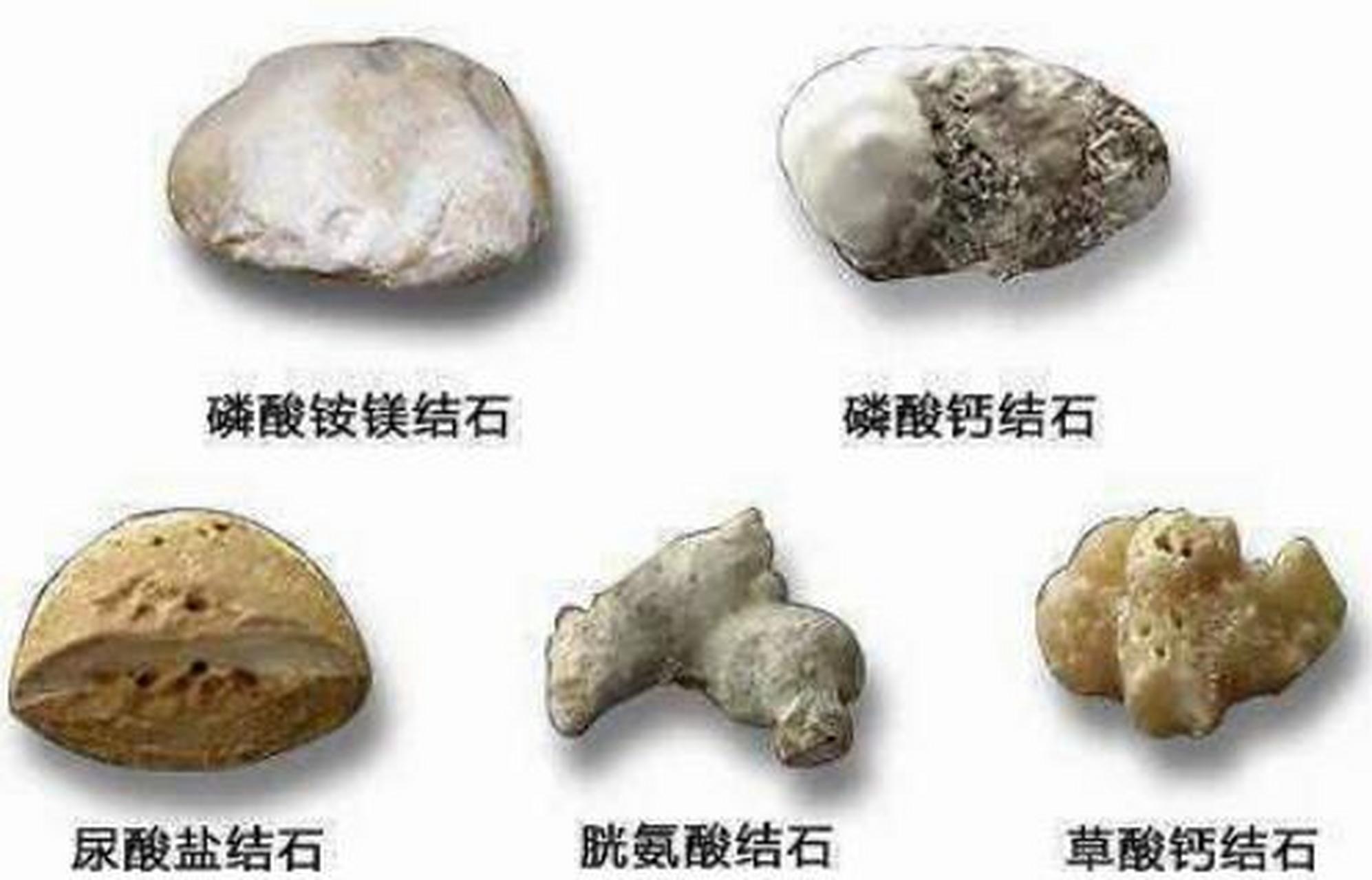 肾结石有什么症状#肾结石#肾结石也就是肾脏出现结石的一种疾病