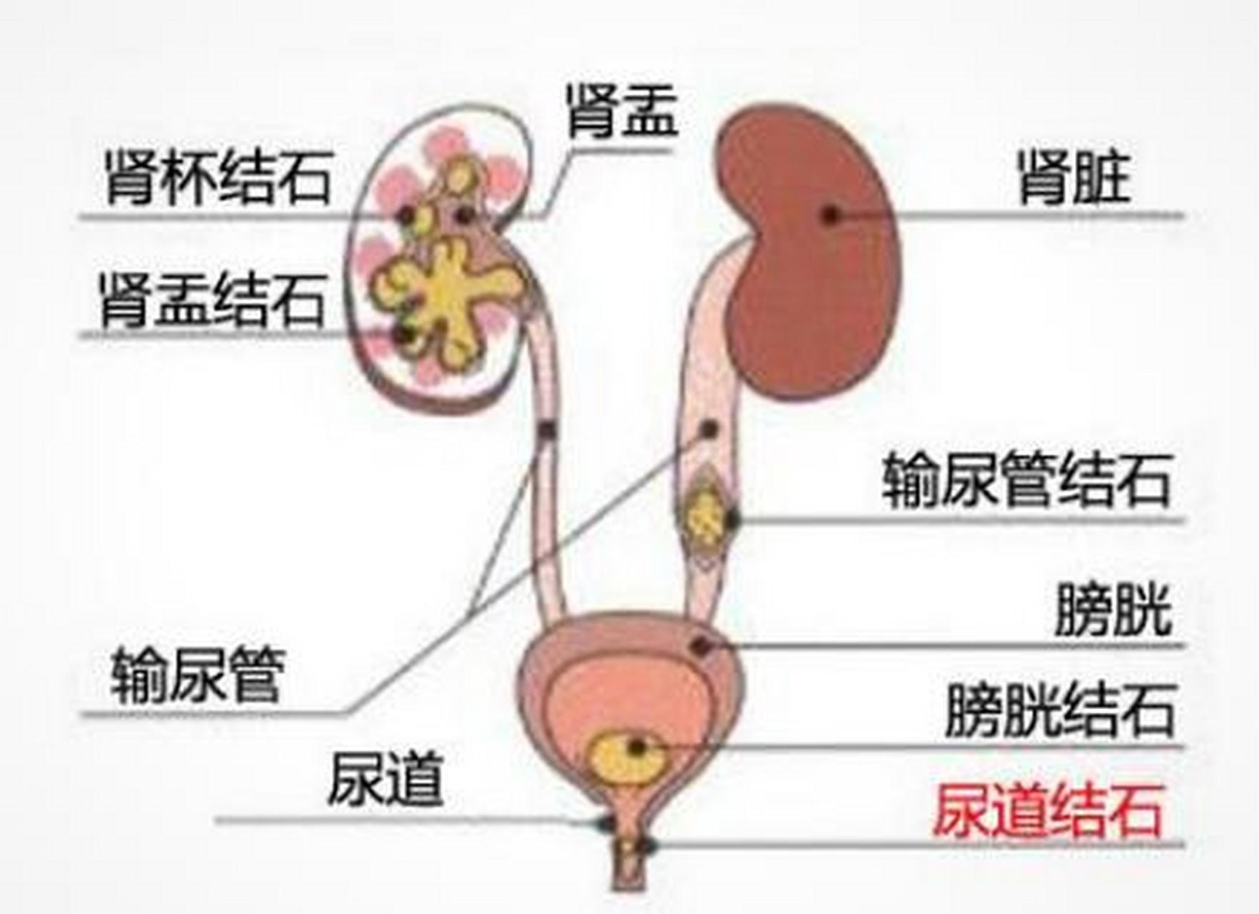 输尿管结石#输尿管结石主要症状是疼痛,主要表现为腰部或者是腹部
