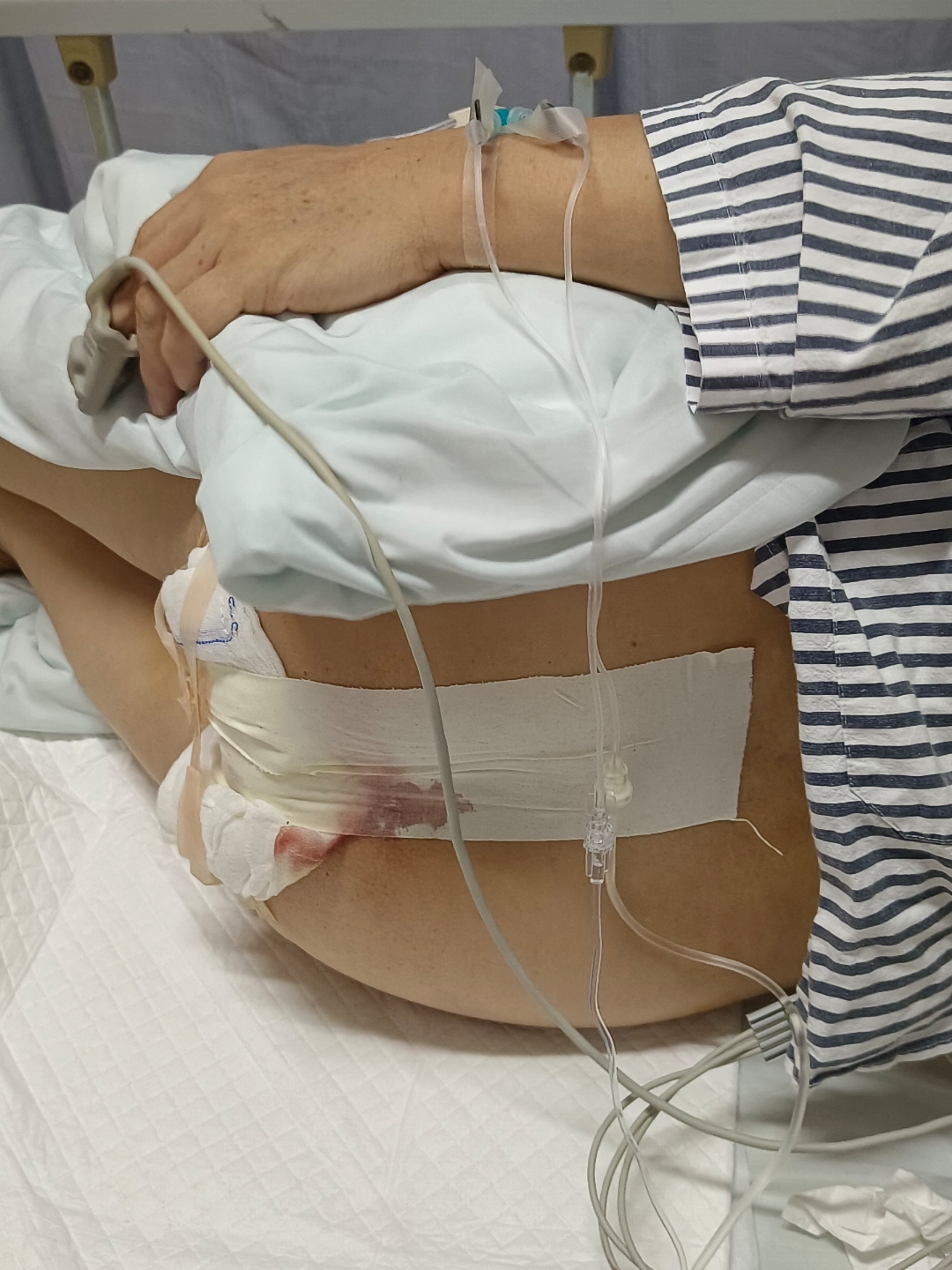 痔疮手术,混合痔动手术.