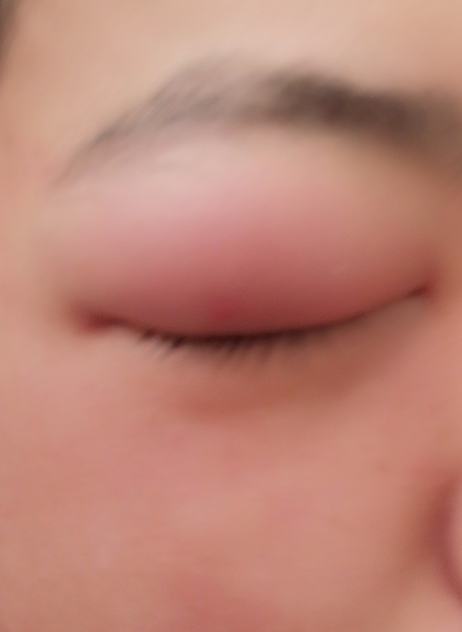 你们的眼睛有被蚊子叮咬过吗?