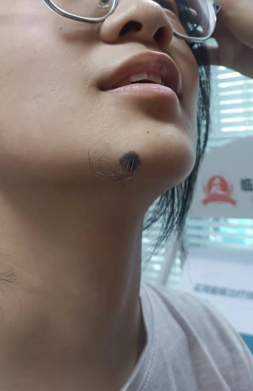 可是好多人见了都说是个有福的痣,不要动它.