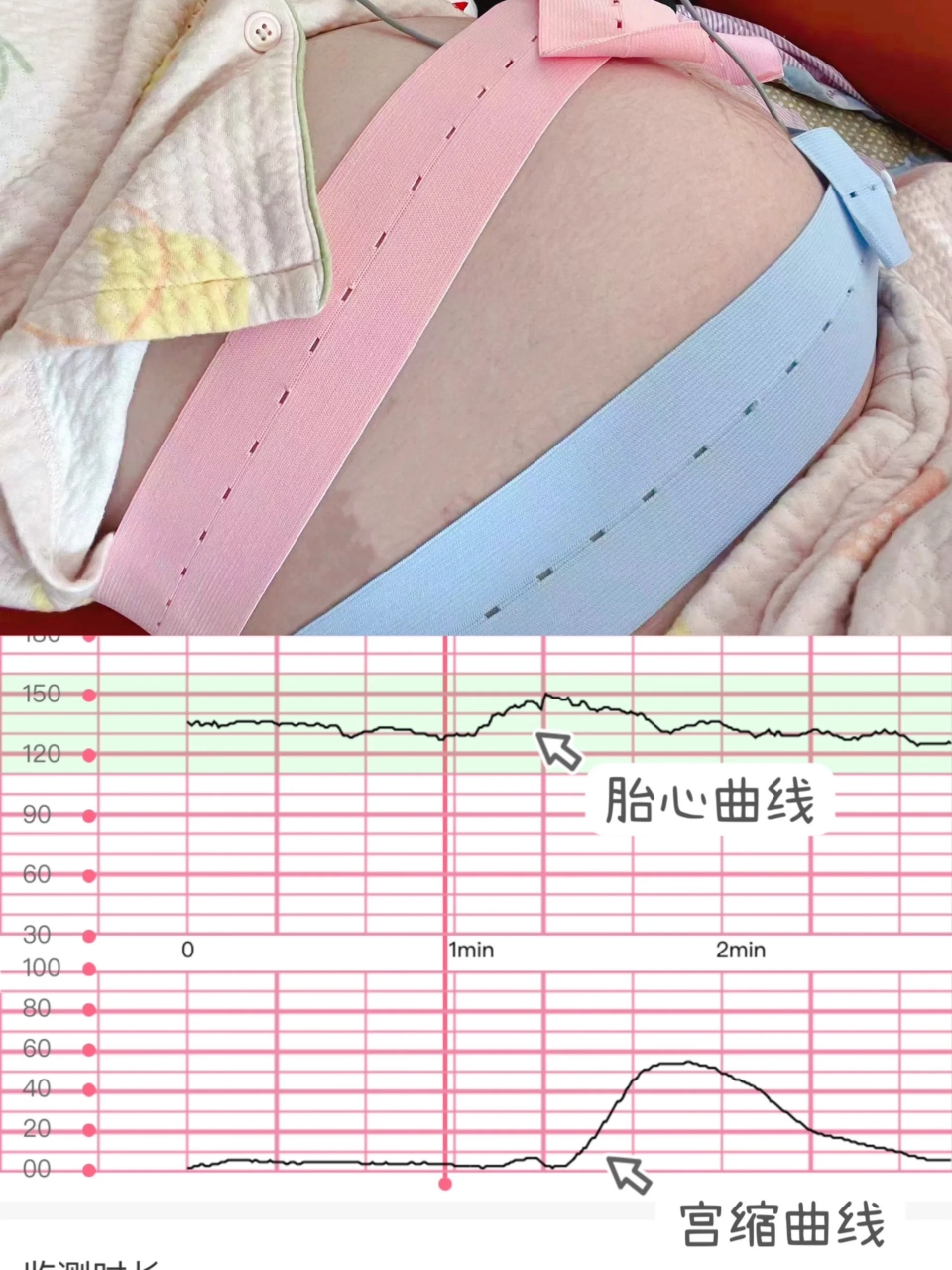 哇哦,这胎心监护曲线和宫缩曲线看起来都挺平稳的,宝贝儿在肚子里应该