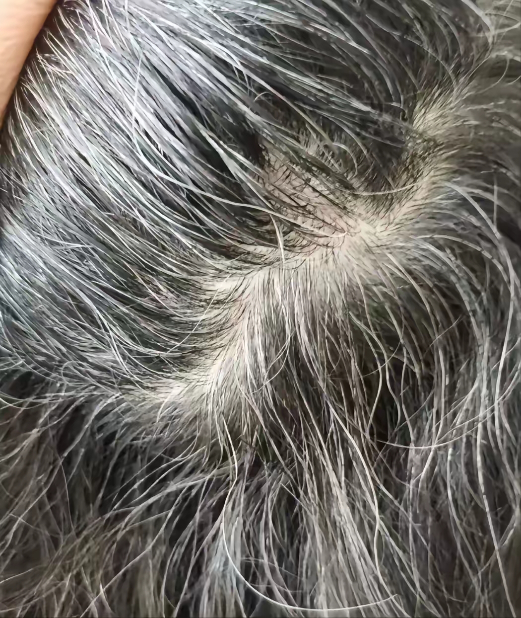 为什么突然有白发