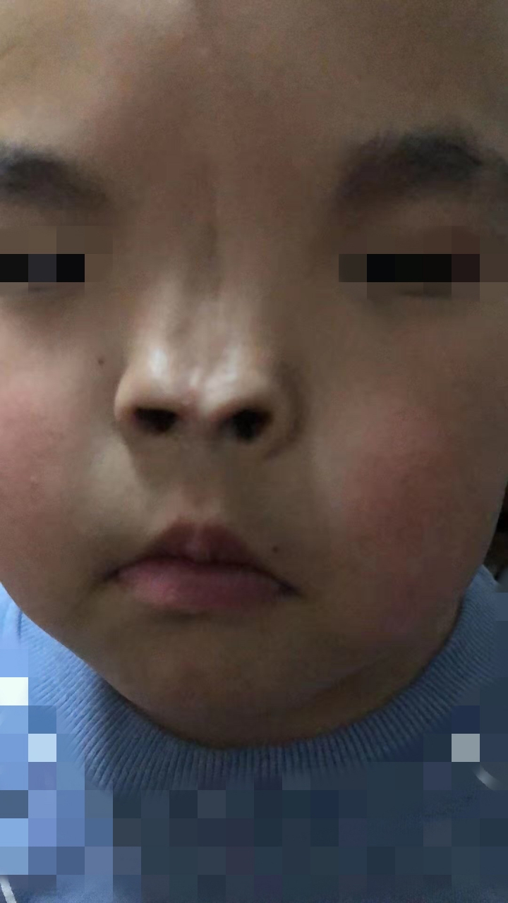 整形#这个鼻子是先天性疾病所致的脸裂鼻,要矫正这种鼻型,需要多次