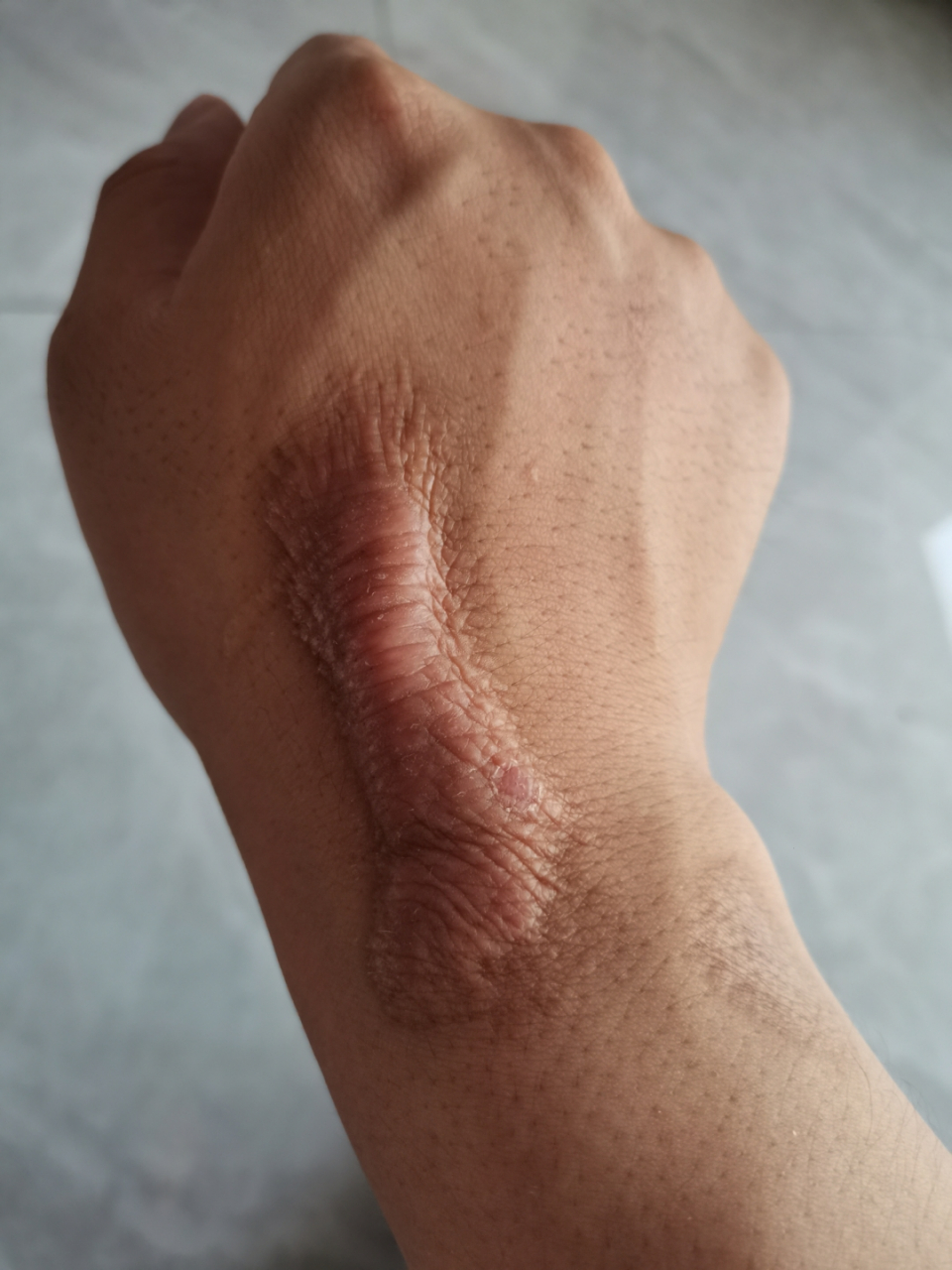 这样的大疤怎么处理