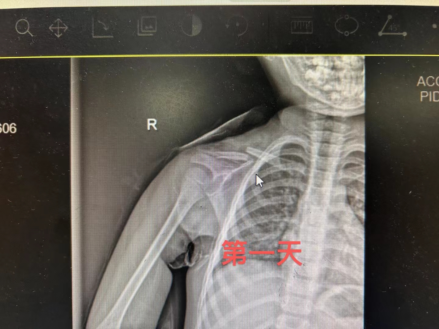 刺激骨痂生长的办法图片