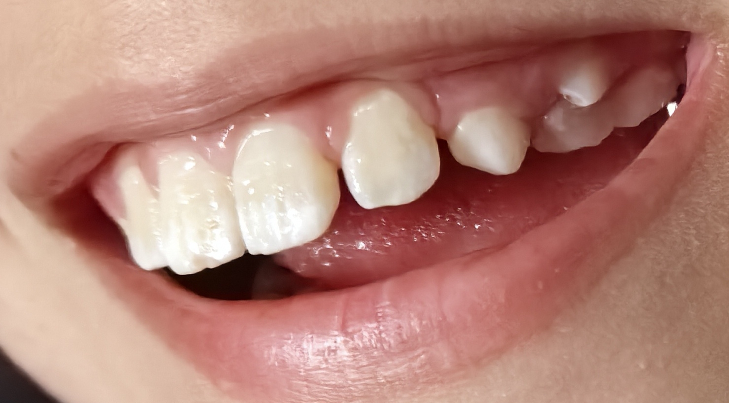 世界奇迹双重牙