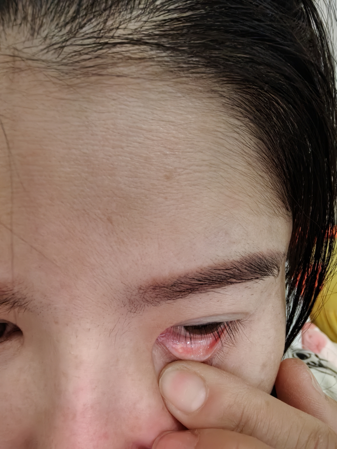 眼睛内侧长了疙瘩