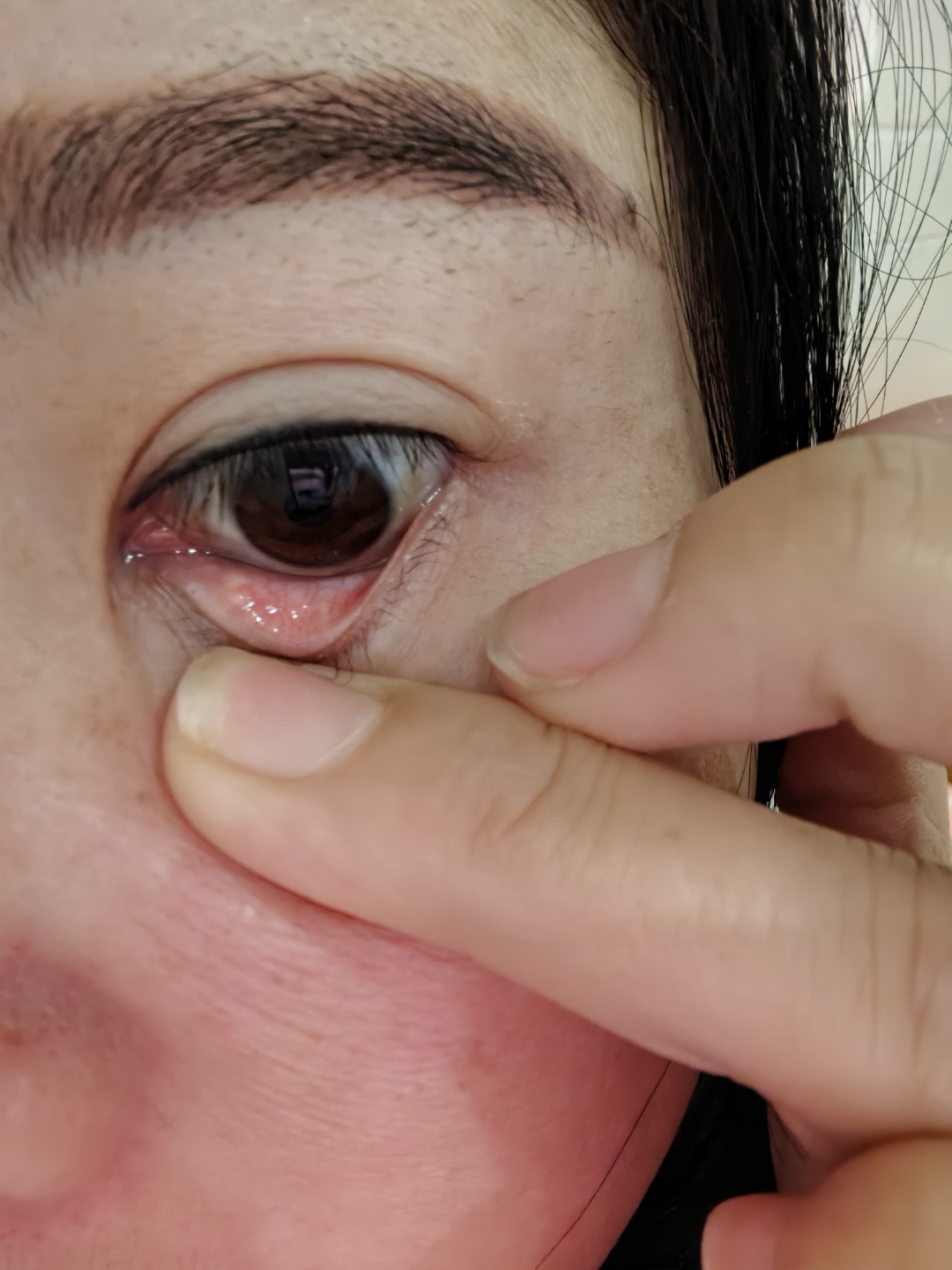 眼睛内侧长了疙瘩