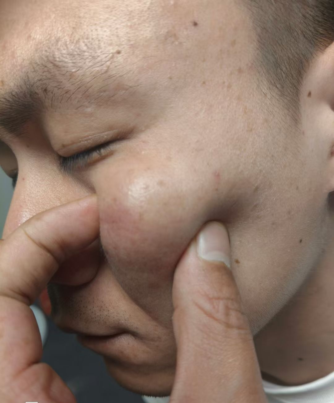 皮下鼓包,一看一摸就知道是什么瘤这就是经验,十