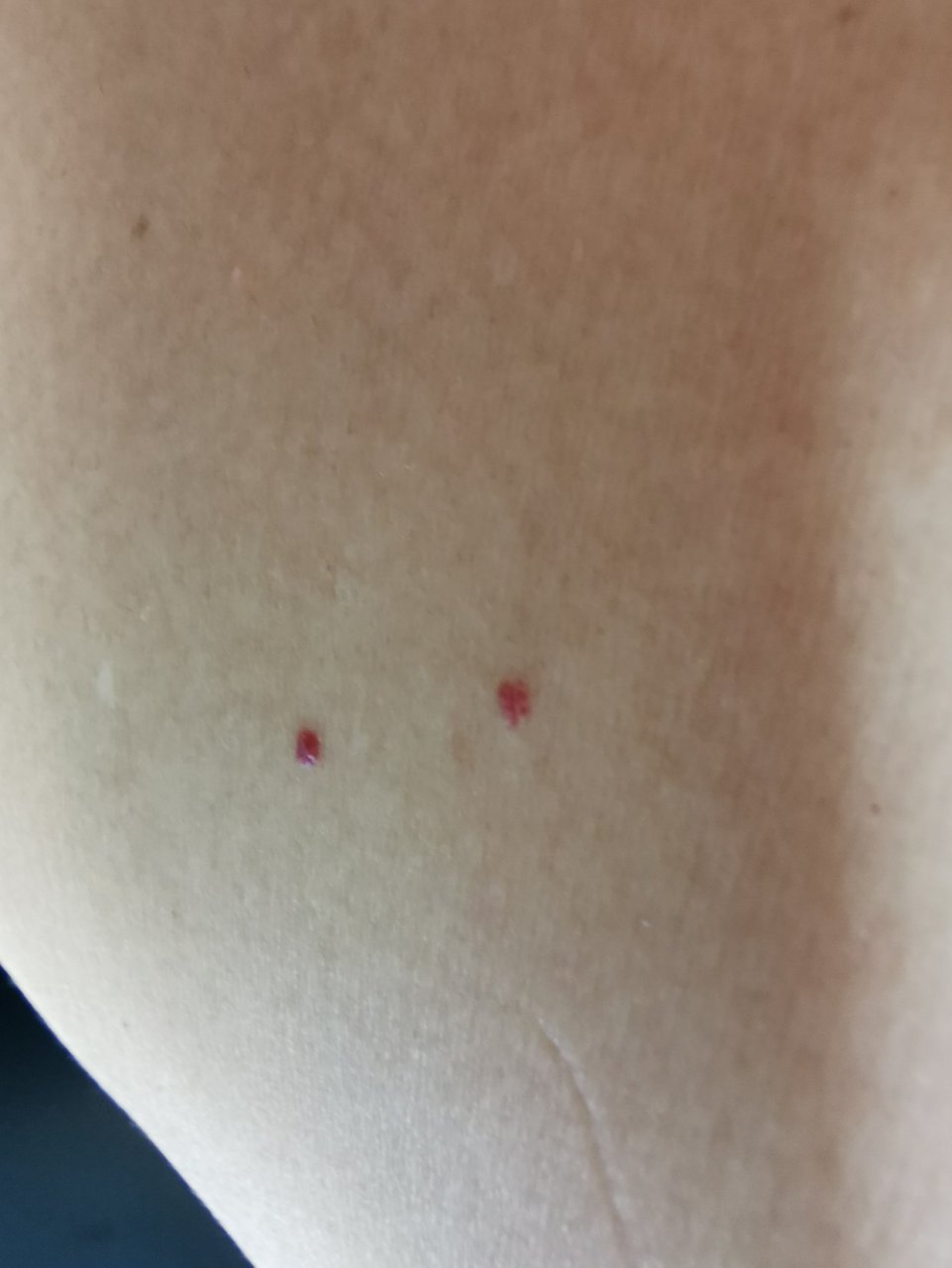 身上长这种红点是怎么回事?