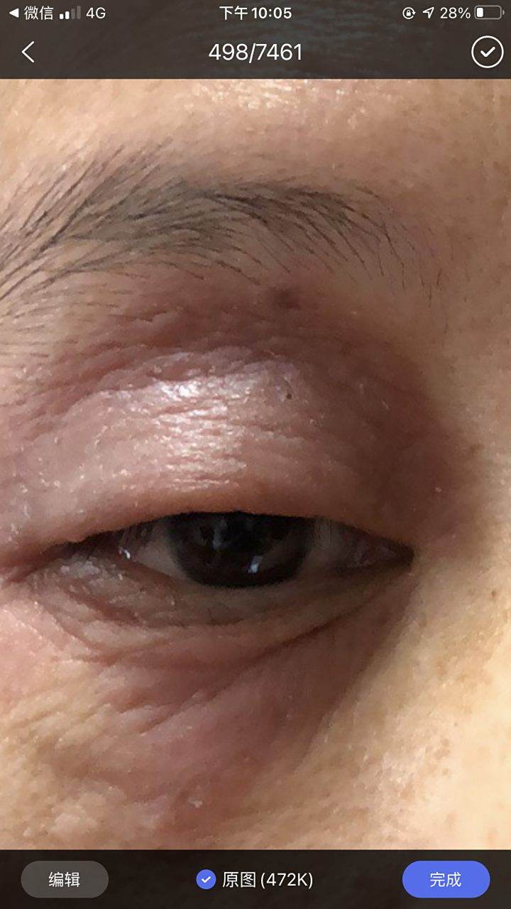 中年女性由于近期生活工作压力大,双眼皮起红斑瘙痒,外用药物治疗后