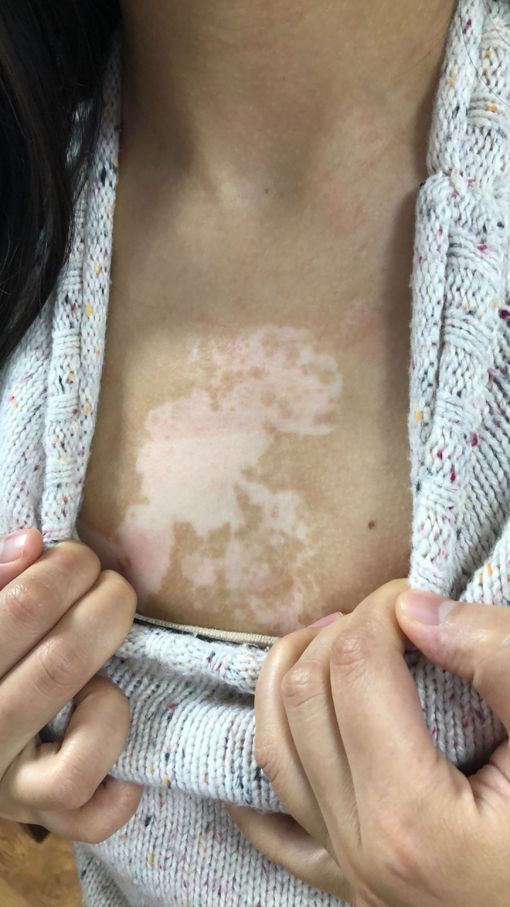 这位年轻女性的白癜风,面积有点大,需要间歇性长期间歇性治疗,用药