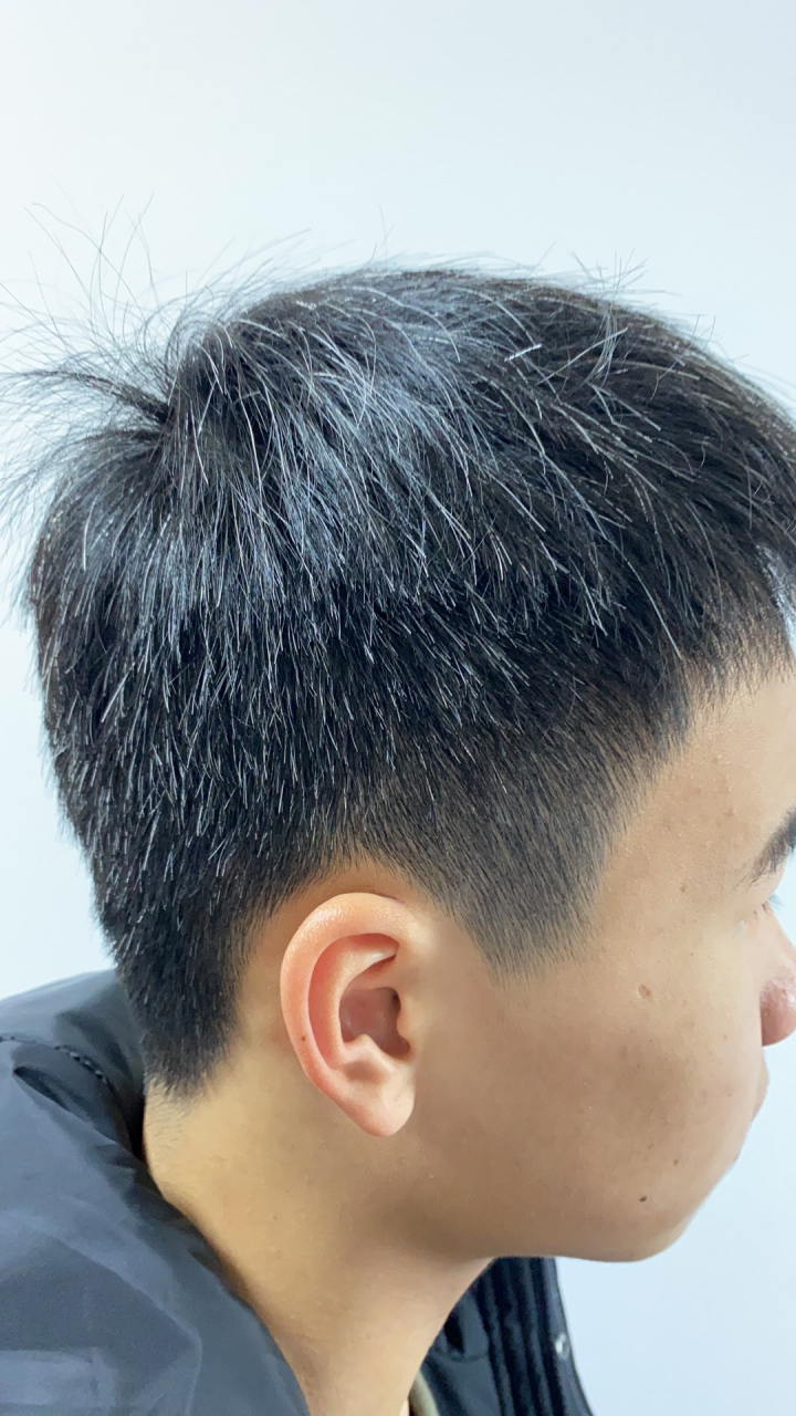 这个少年儿童满头白发,确实比较严重,这个皮肤病就叫白发,没有特殊的