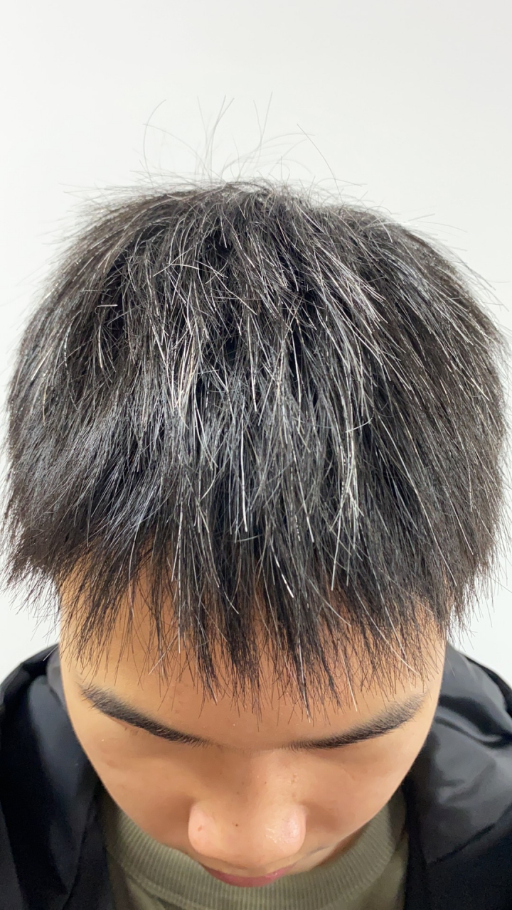 这个少年儿童满头白发,确实比较严重,这个皮肤病就叫白发,没有特殊的