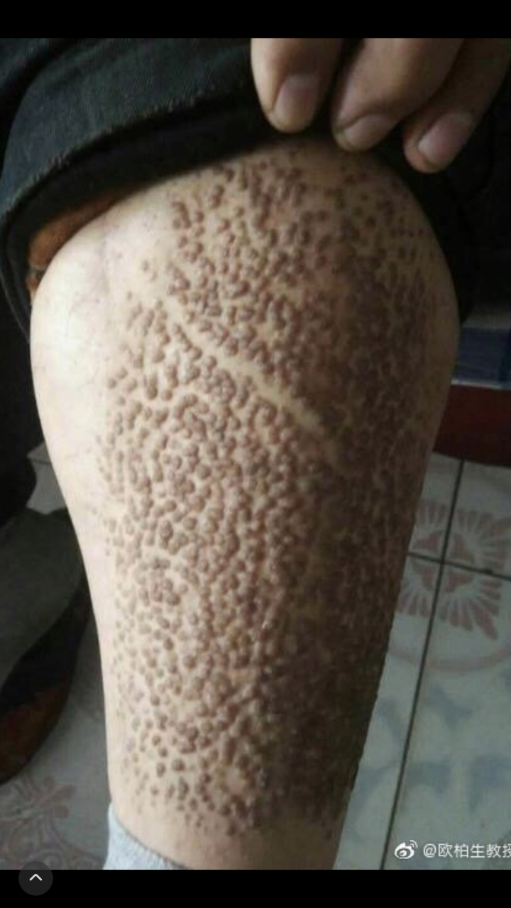 皮肤淀粉样变 这位患者背部的皮疹非常貌似湿疹,实际上她的皮肤病是