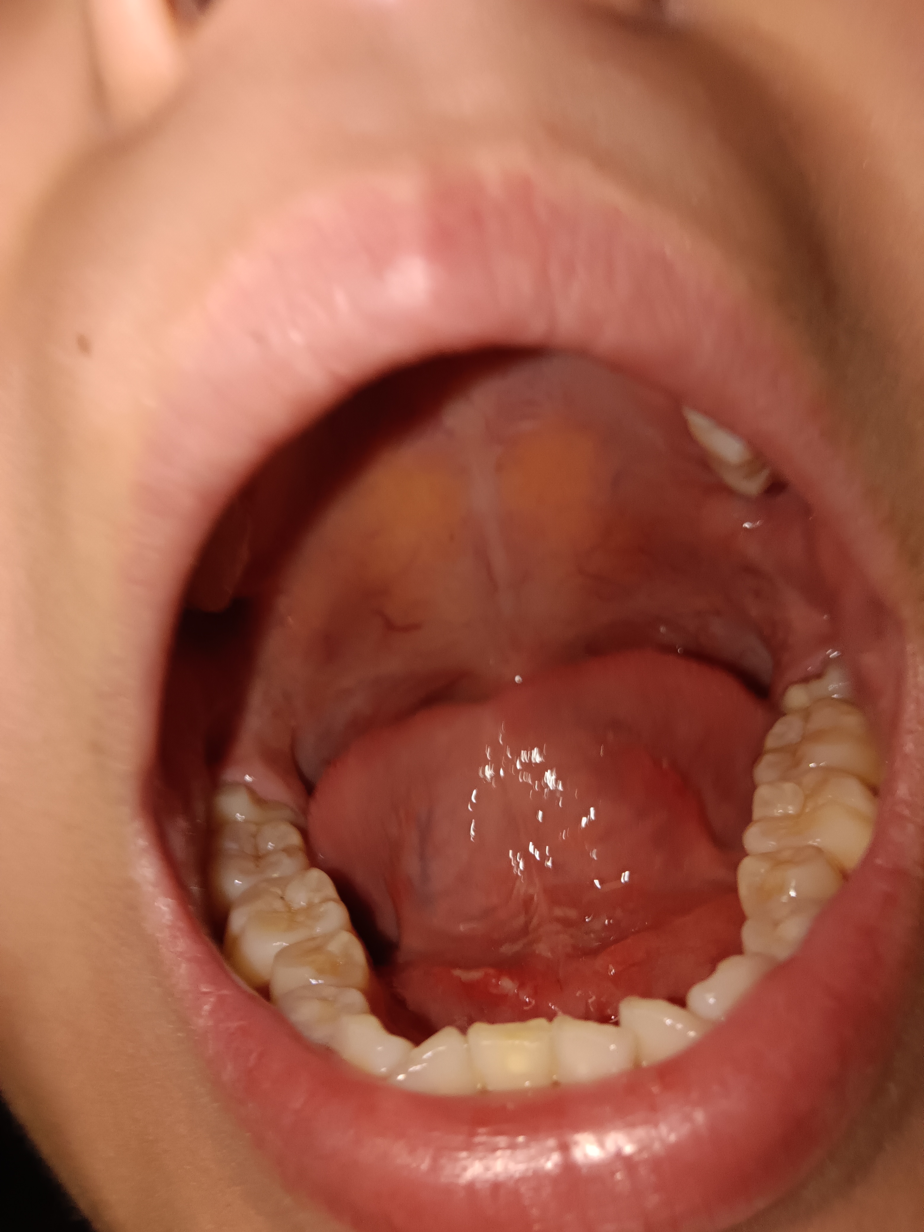 病友交流中心# 我这个舌头下面是怎么回事啊,有没有大神知道啊,前