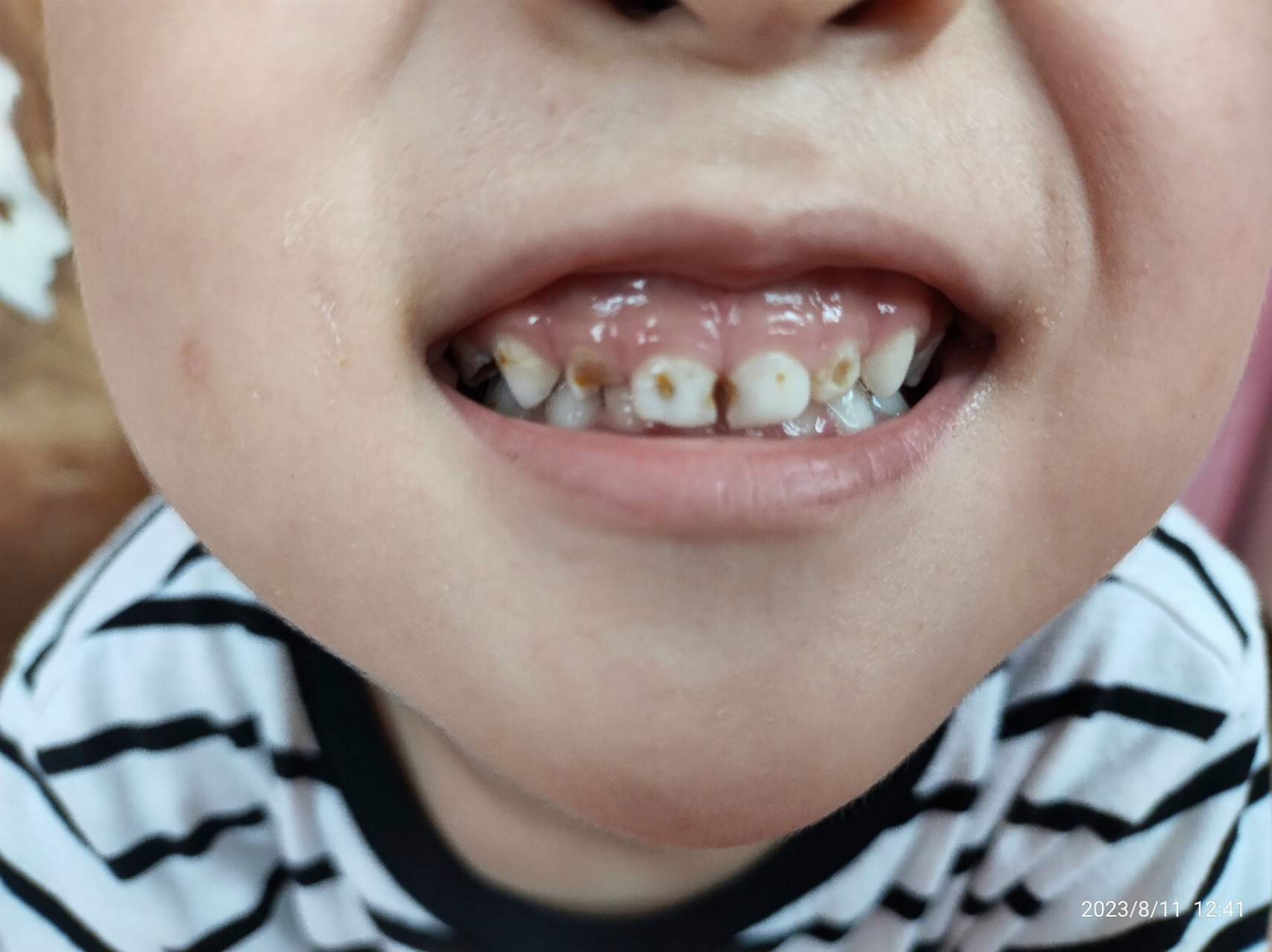 小孩子蛀牙可了不得,现在的小孩食品甜度太高了,牙齿都坏了