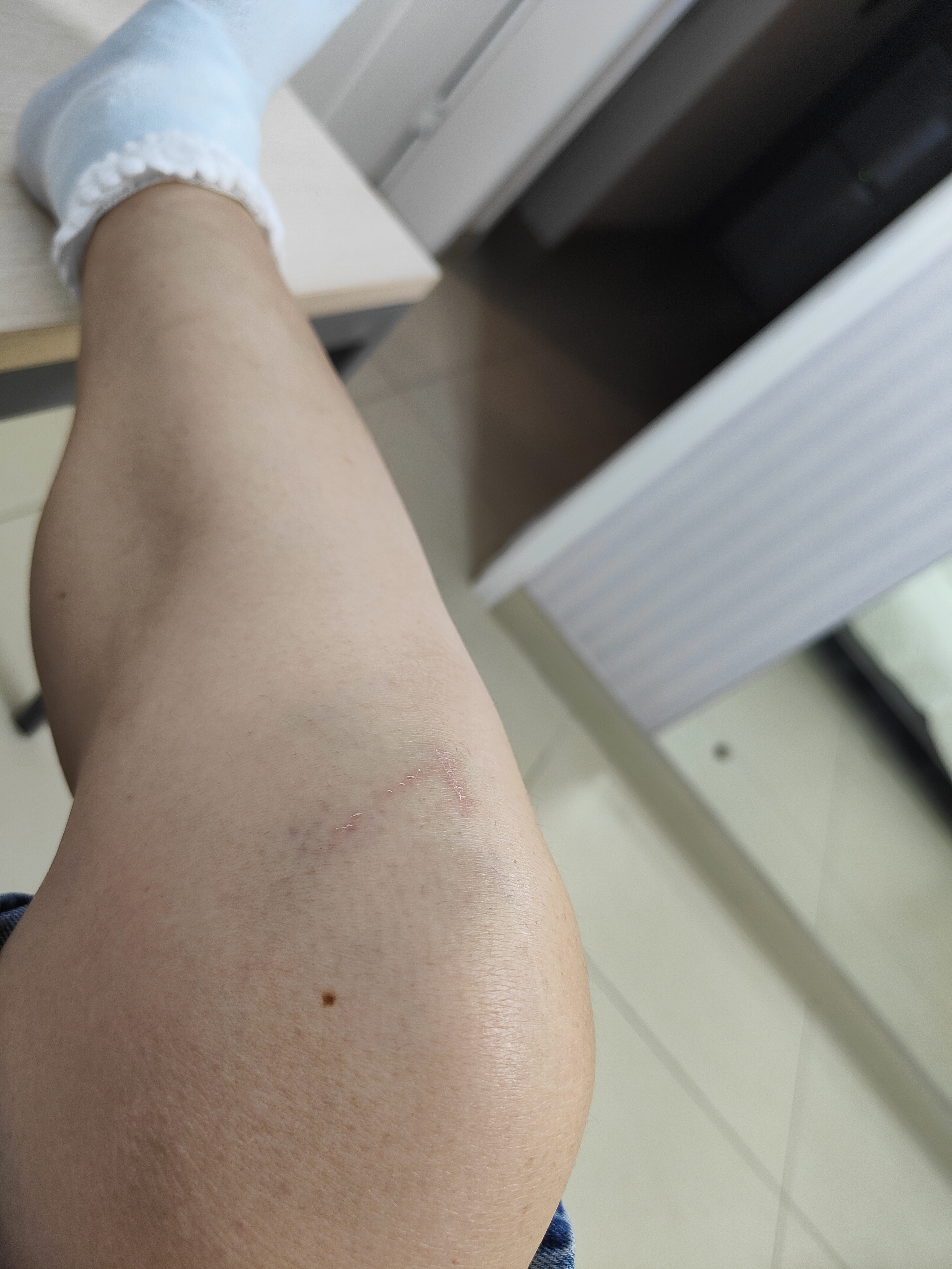今天中午去洗车,地太滑,滑了一跤,膝盖摔紫了,幸亏脚踝没有受伤