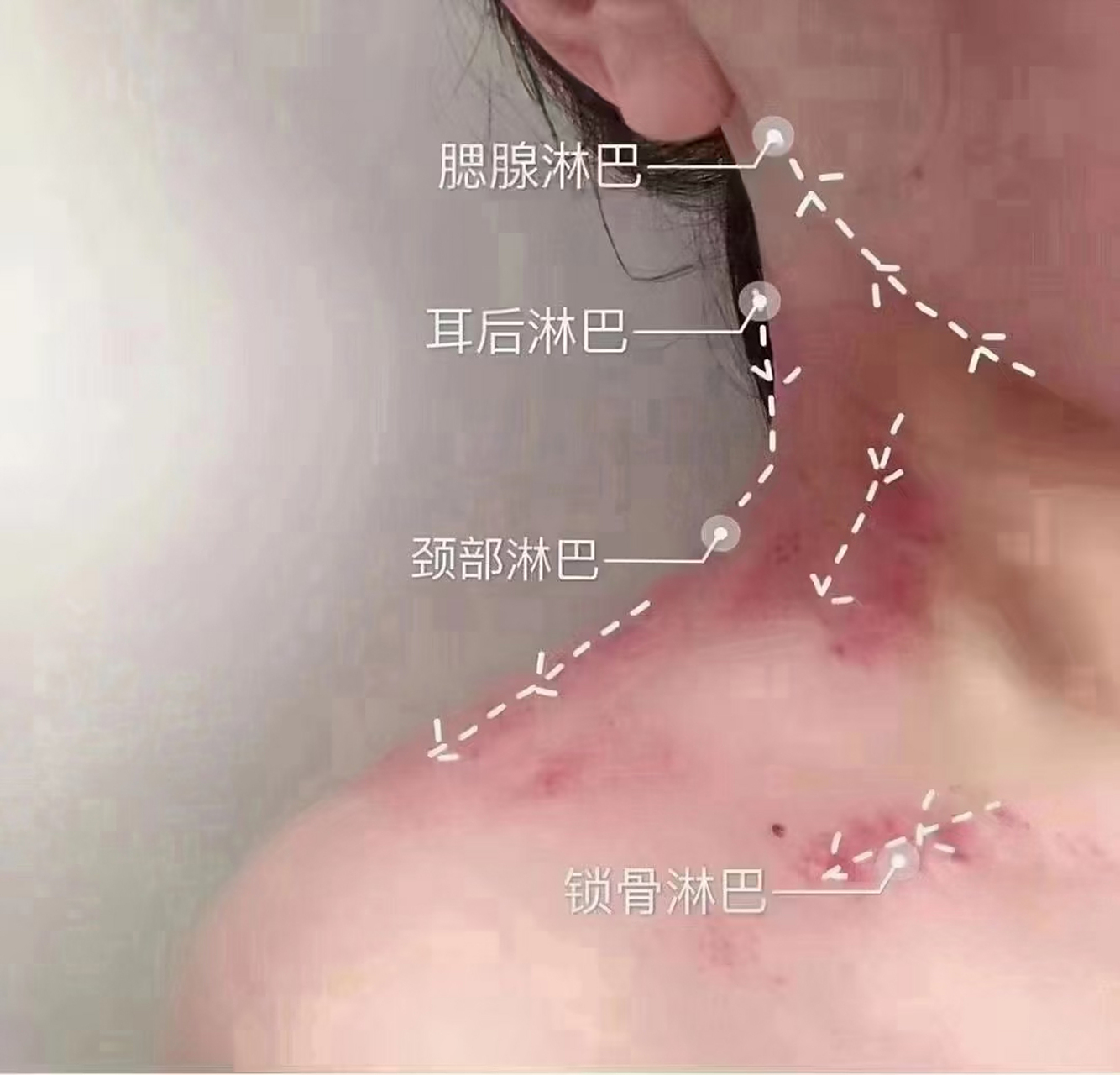 [心]淋巴淤堵的危害: 1:就是觉的头疼 2:咽部嗓子不舒服 3:脖子转不动