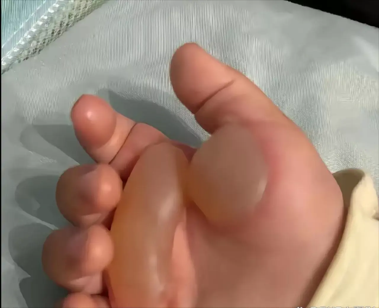 邻居家一岁宝宝被开水烫伤起水泡 邻居家一岁宝宝没看住,摸了刚烧开的