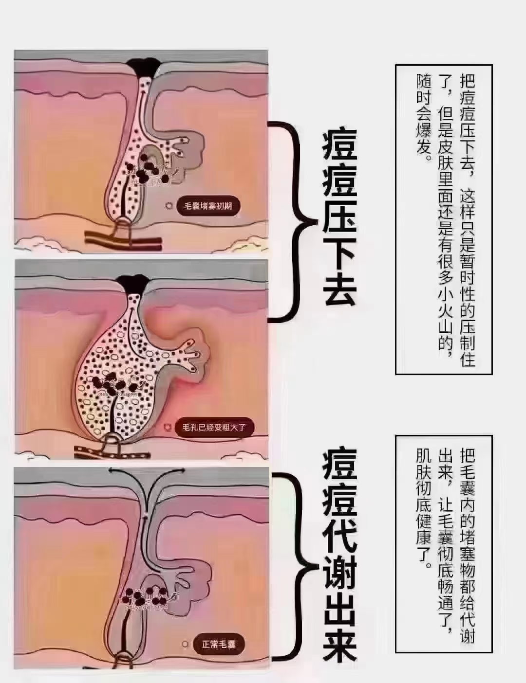 毛囊堵塞怎么治疗图片