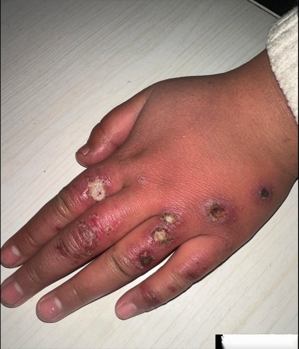 昨天我回家给我妈送香肠,看到我十岁的侄女手长冻疮,好家伙,有些地方