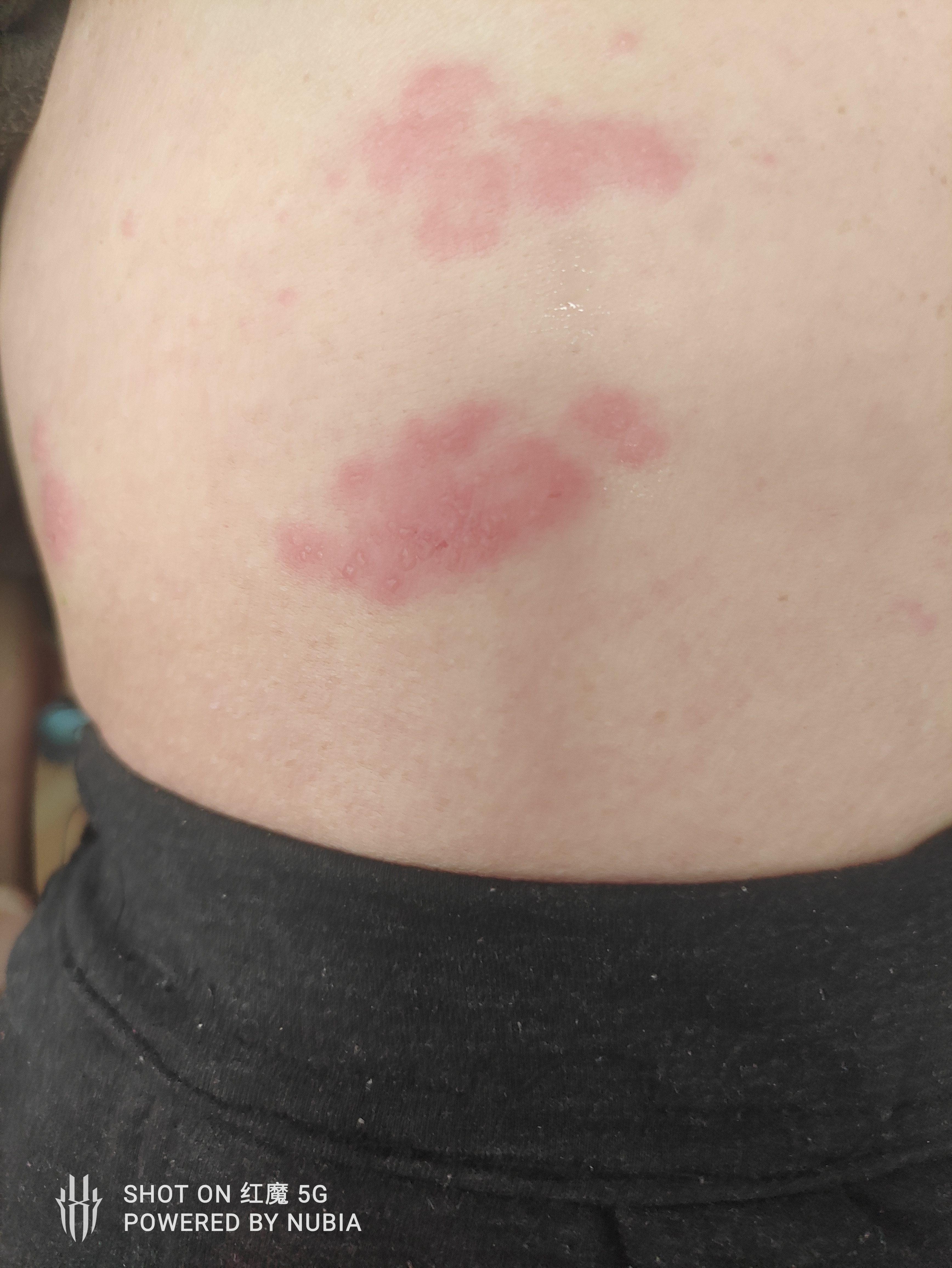 老人腰上长的这个点儿看这是啥.