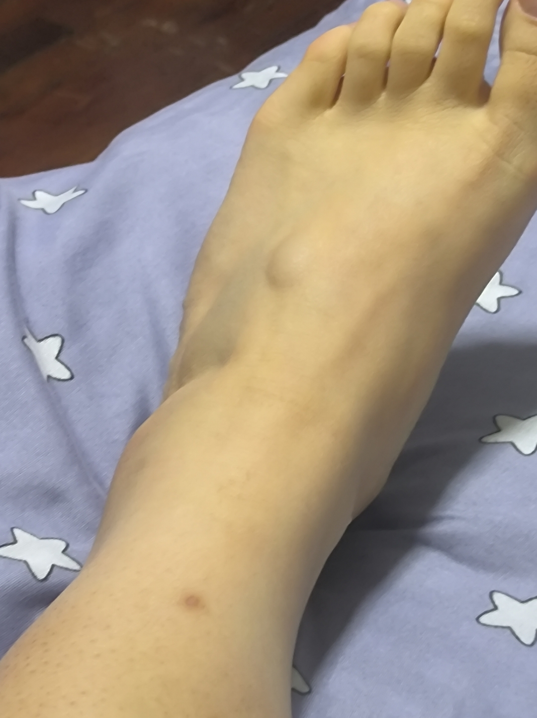 为什么我的脚背上有个包啊 好小就有了 也不痛 也不痒的 但是感觉有点