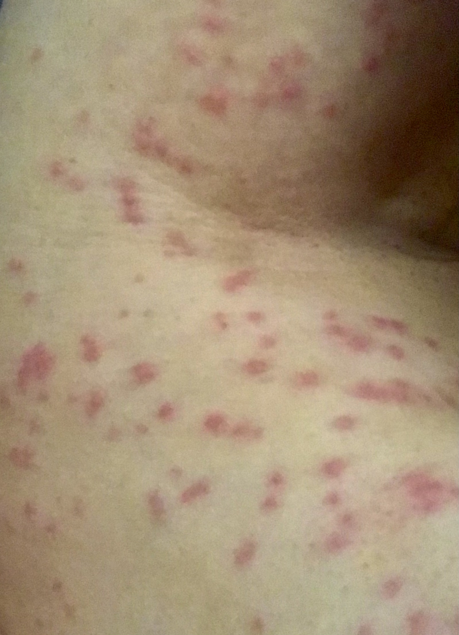 打新冠疫苗第一针过敏了,爆发一片片红疹!