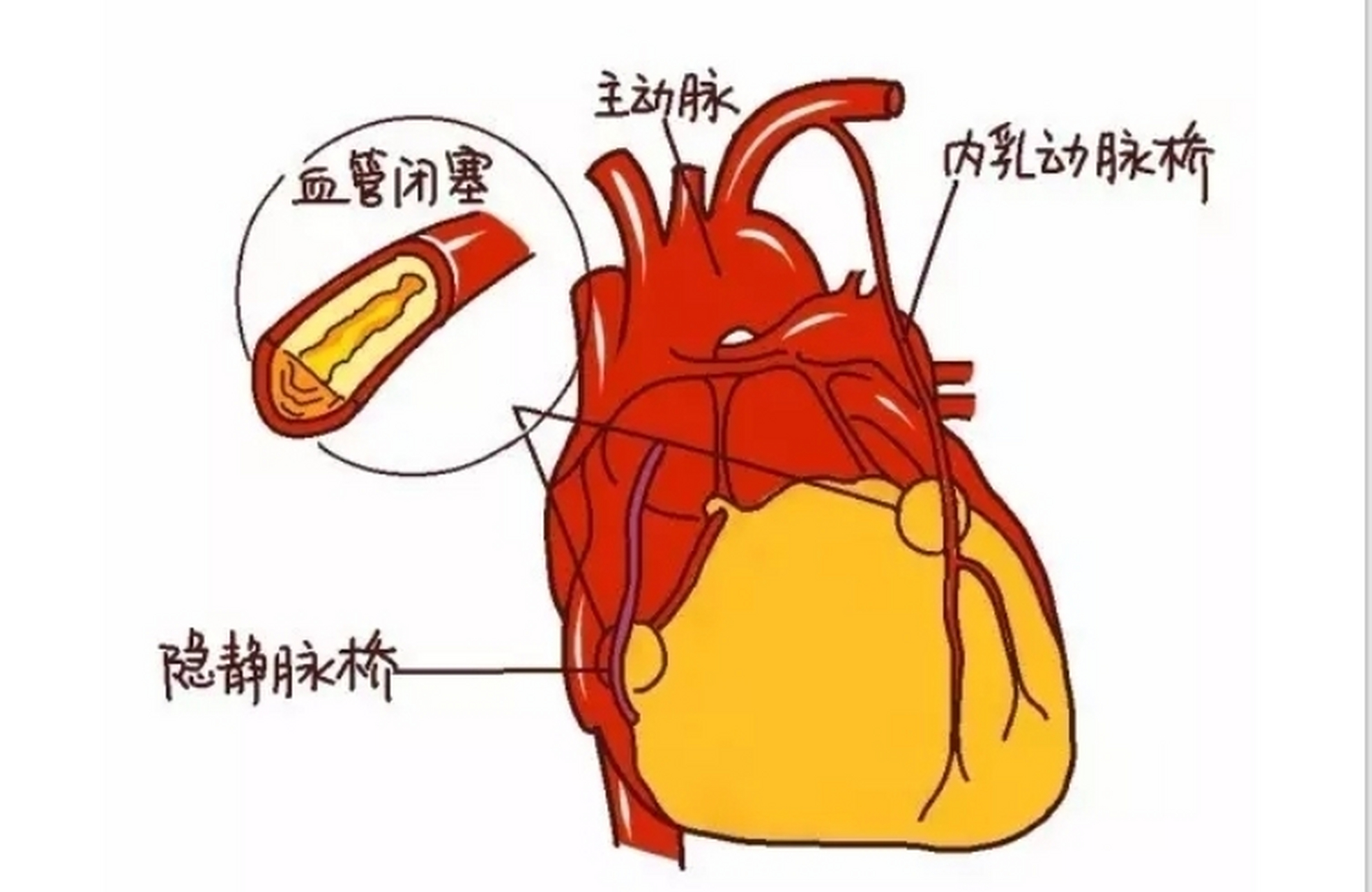 冠脉循环示意图图片