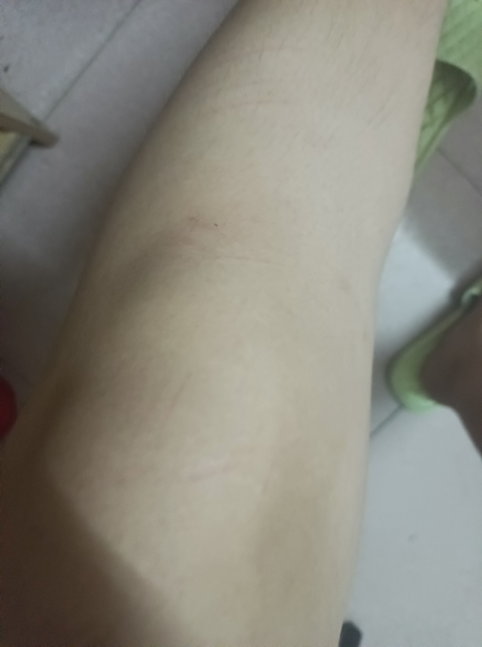 睡一觉起来,腿上突然出现刀伤疤,像是拿刀划的那种,这种是什么原理