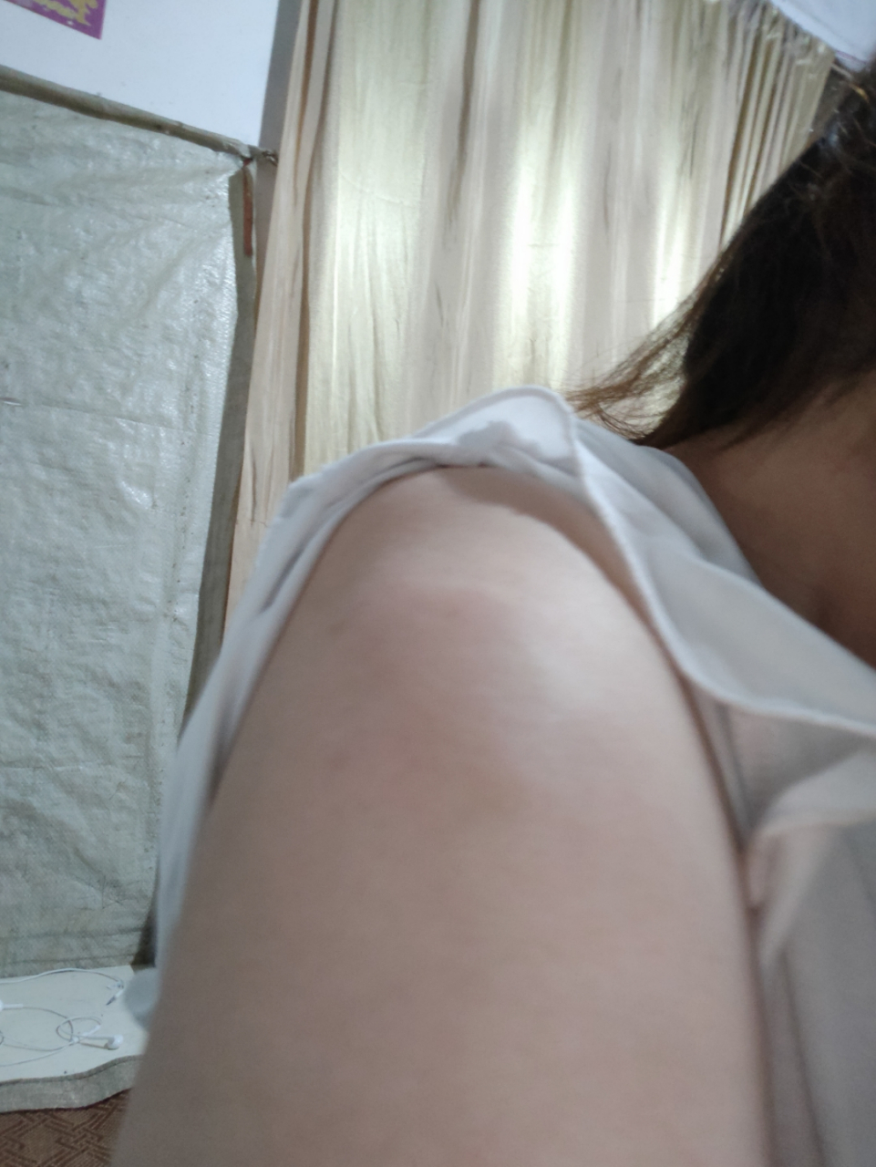 打完安徽智飞第三针肿的好厉害又痛又肿又痒