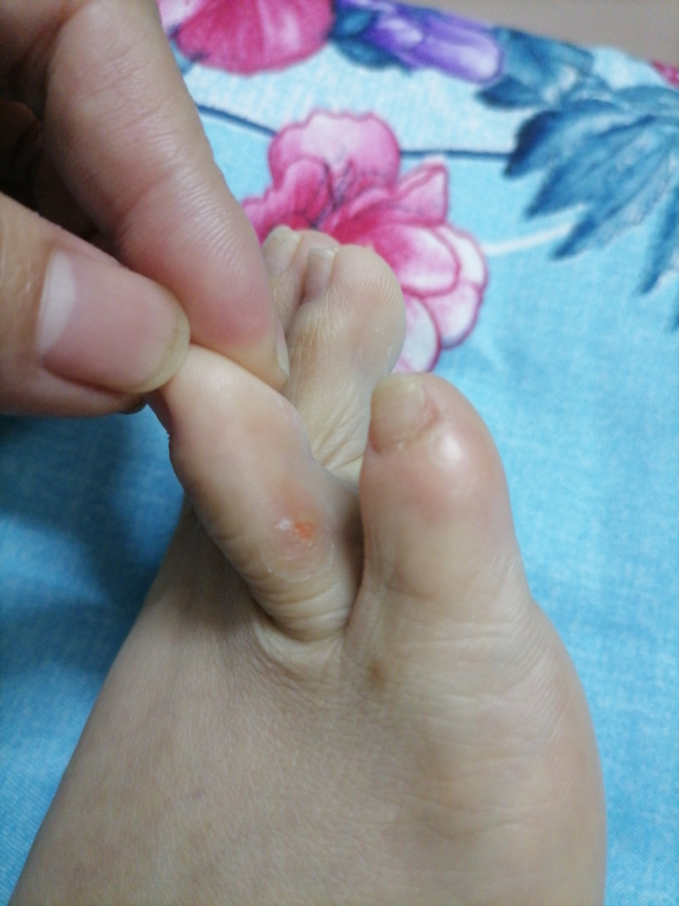 脚趾上的鸡眼掉了,贴鸡眼贴还是很有效果的呀[微笑]