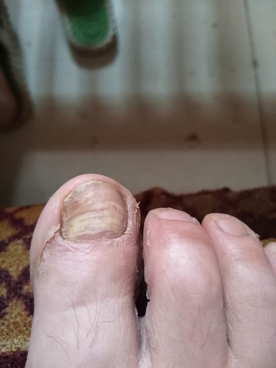 这样发白的脚指甲,是缺什么吗?