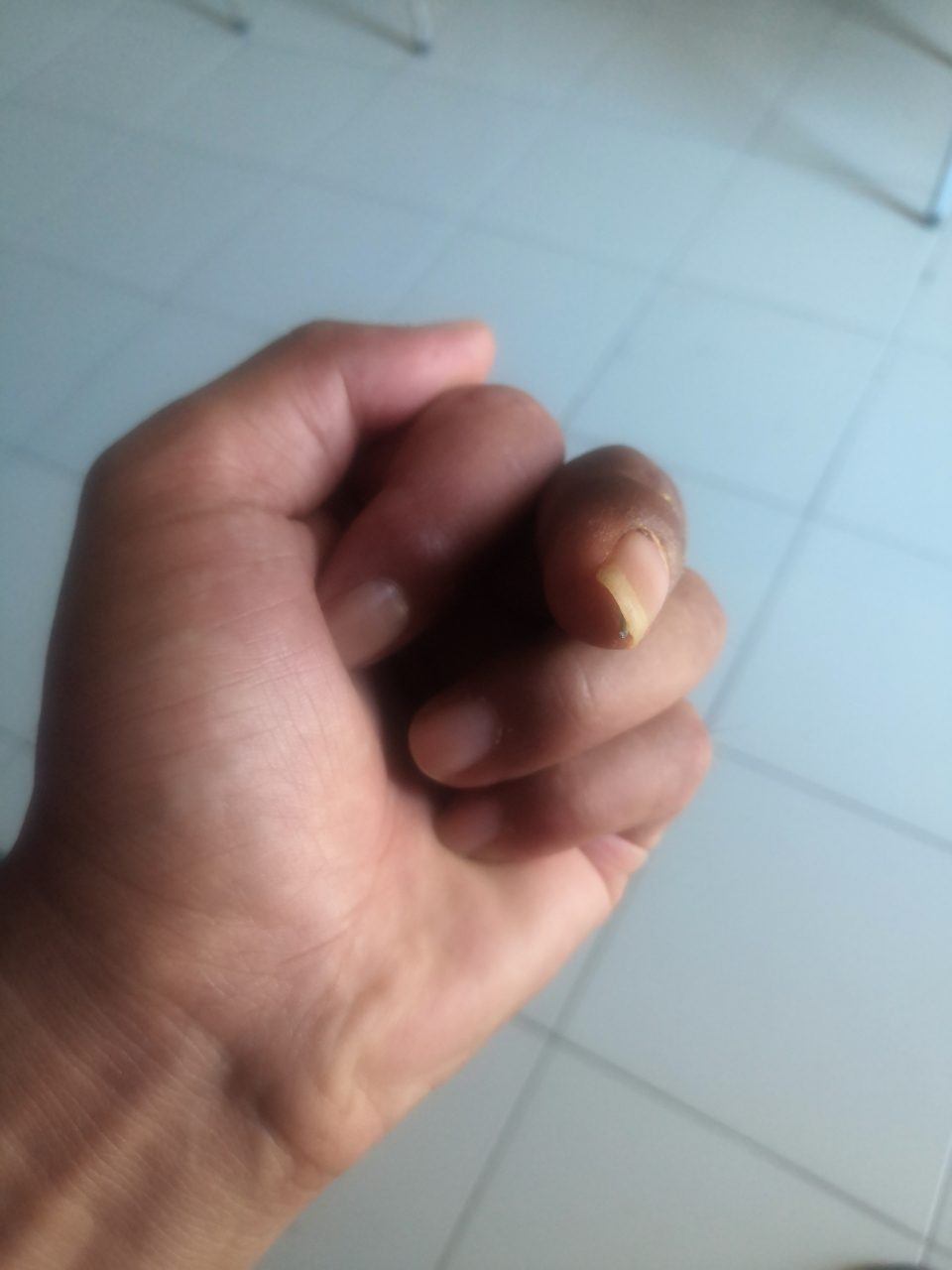 左手中指肌腱损伤,无法修复,做了关节融合手术,使手指不能弯曲,请我